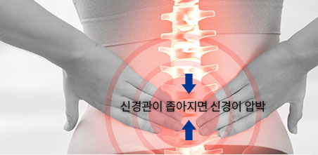 요추 협착증, 요추 척추관 협착증